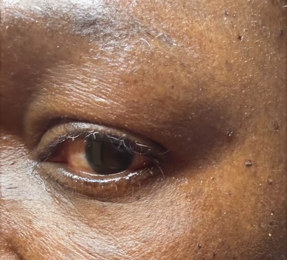 After: clearer skin around the eye