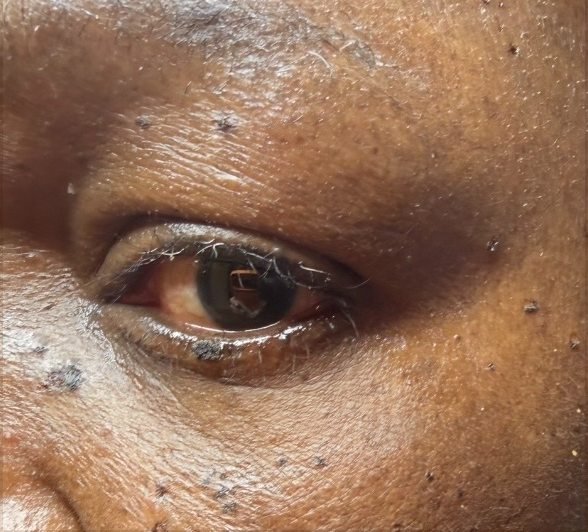 Before: small raised spots around the eye on deeper skin