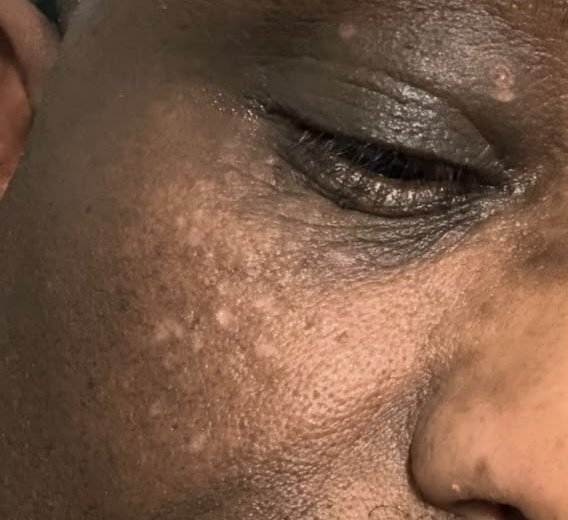 Healing: tags removed, light marks fading