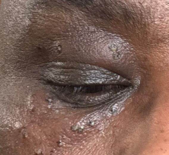 Before: raised skin tags around the eye and cheek on deeper skin