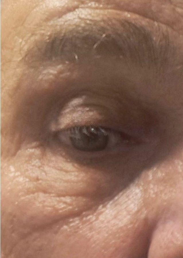After: smooth upper eyelid