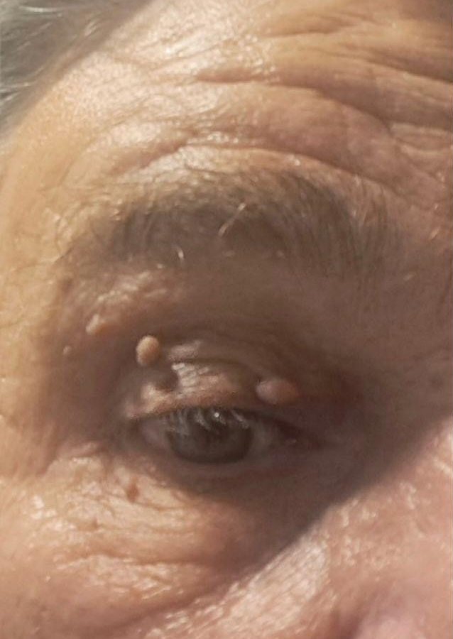 Before: several skin tags on the upper eyelid and brow