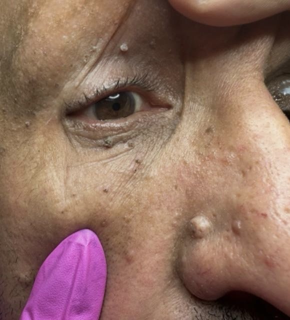 Before: skin tags beside the nose and on the eyelid