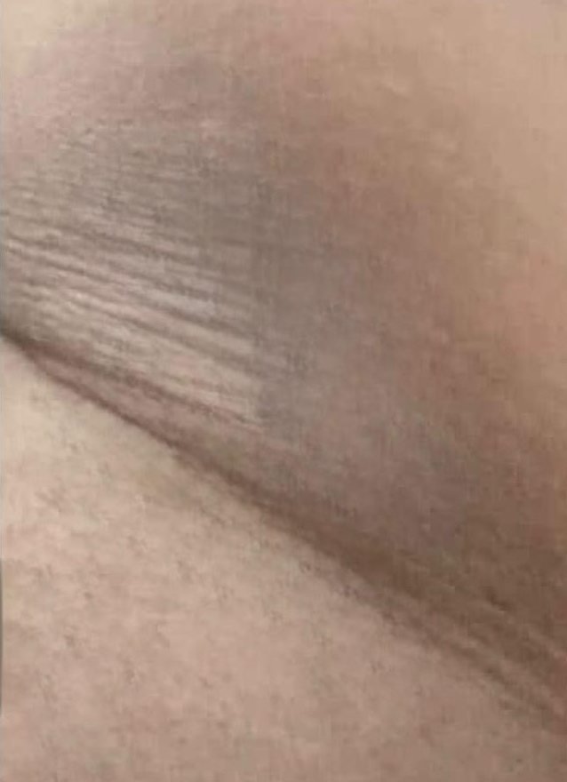 After: smooth underarm skin