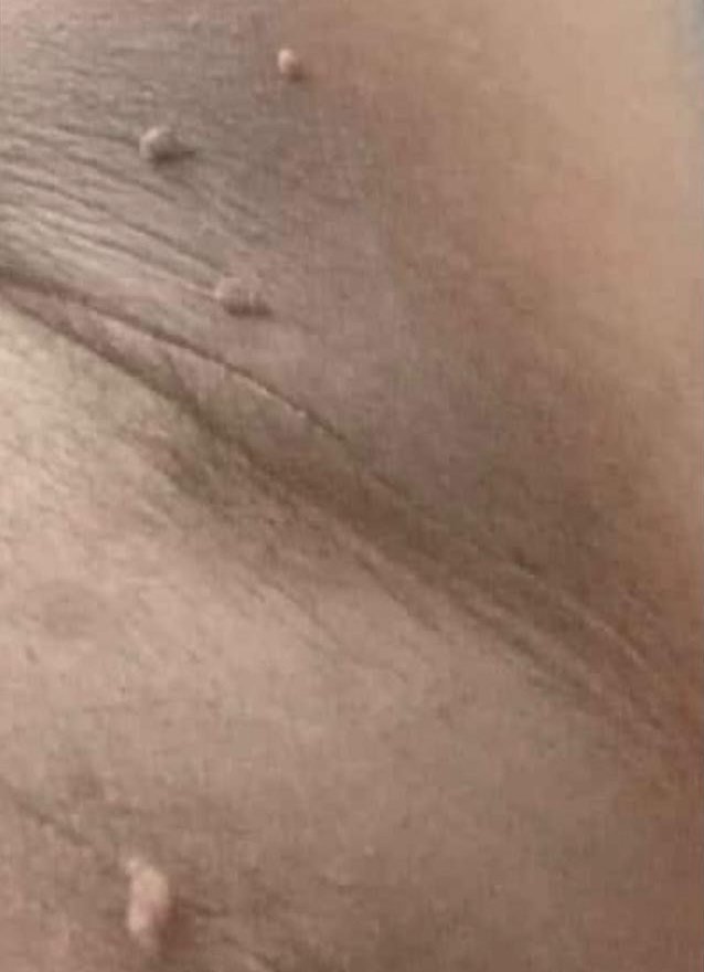 Before: four skin tags in the underarm crease