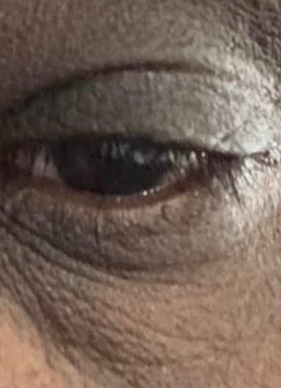 After: smooth upper eyelid
